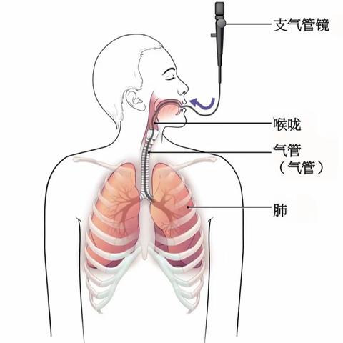 【病案分享】一探究“镜”——吸入性肺炎的支气管镜治疗