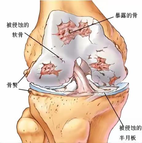 膝骨关节炎的防护与治疗