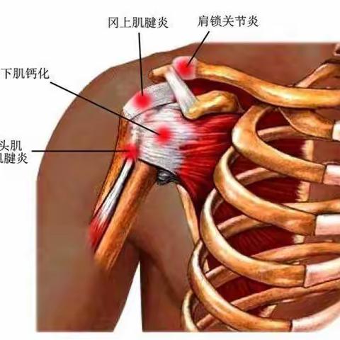 健康科普|拯救被“冻结”的肩，运动康复来帮您