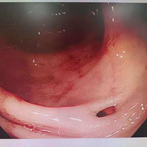 攻坚克难，内镜下精准止血——成功救治结肠憩室出血患者