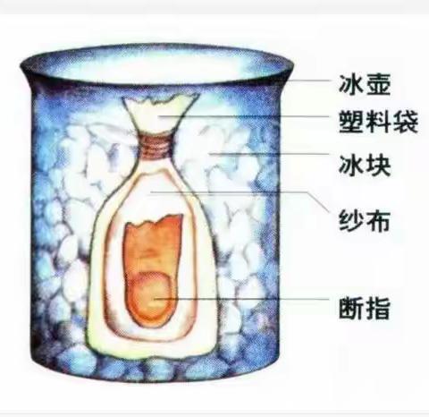 手部炮炸伤紧急处置方法