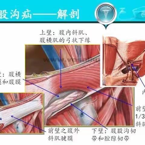 普外科新技术—TAPP治疗腹股沟疝