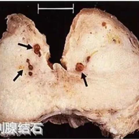 男人健康之路：前列腺结石与前列腺钙化