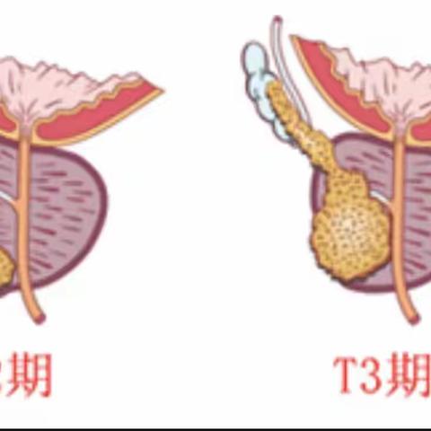 男人健康之路：前列腺癌的早期筛查