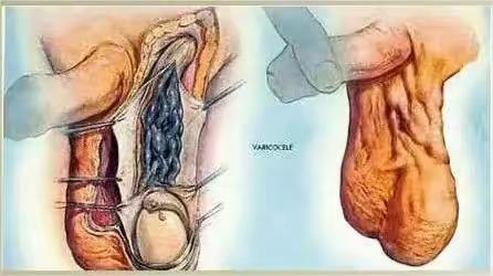 男人健康之路：这个“杀手”不太冷！精索静脉曲张