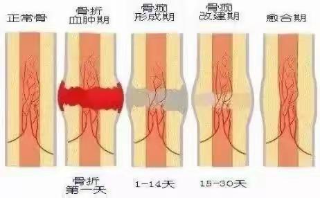 骨折后还抽烟喝酒吗？请立刻停止！