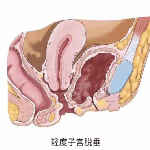 “掉”出来的难言之隐——子宫脱垂