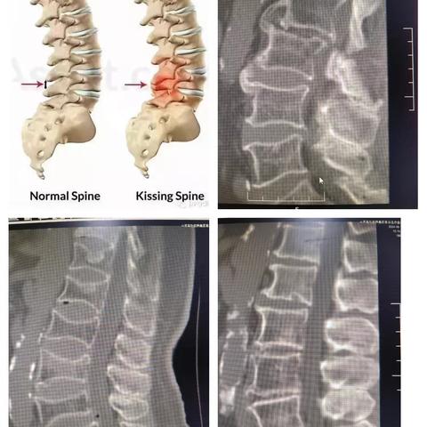 腰痛患者的影像学检查