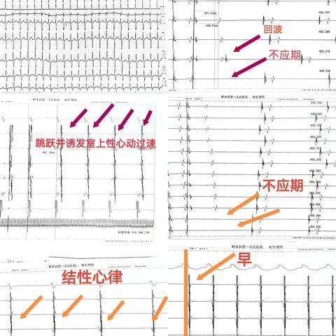 治疗心律失常的“心”希望——心脏射频消融术