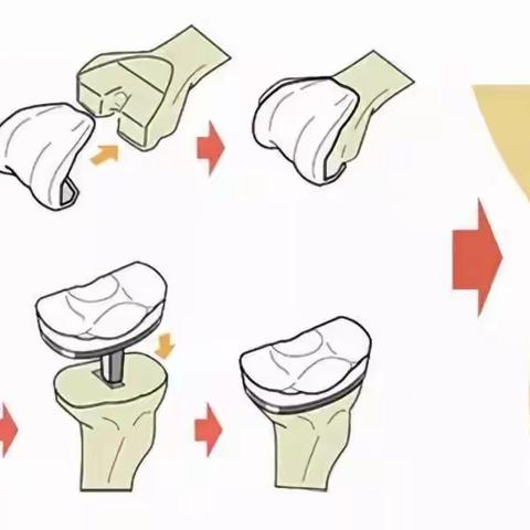 膝关节置换  让关节重新焕发生命活力