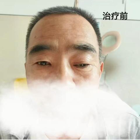 【眼科动态】重获清晰“视”界，他们在这儿找回了眼健康﻿ ﻿——动眼神经麻痹患者康复纪实