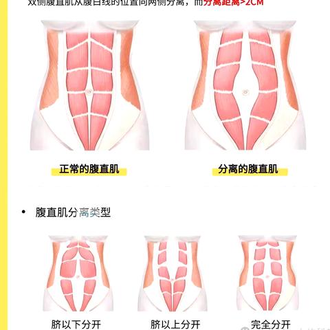 陇南市武都区中医医院康复科【产后康复】腹直肌分离的成因、评估及运动矫正思路