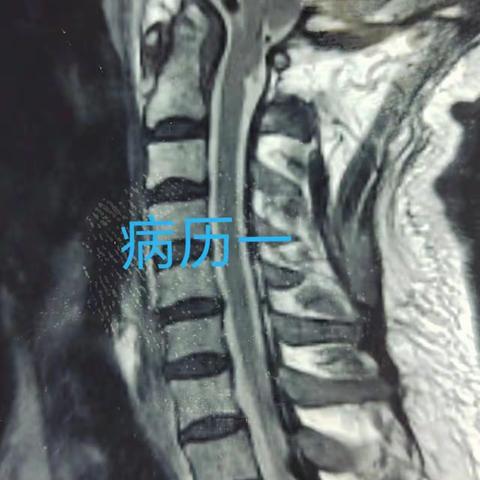 开元神经外科近两周典型脊柱脊髓病历回顾：