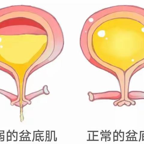 专业级产后盆底康复治疗效果及评定标准