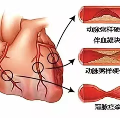 【健康科普】冠心病科普——幸福从“心”开始