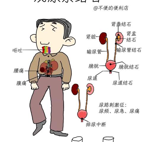 小结石，大危害！