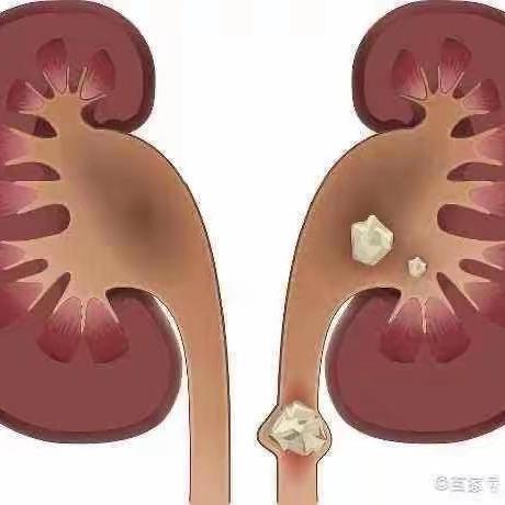 泌尿系结石患者需要注意哪些运动方式？