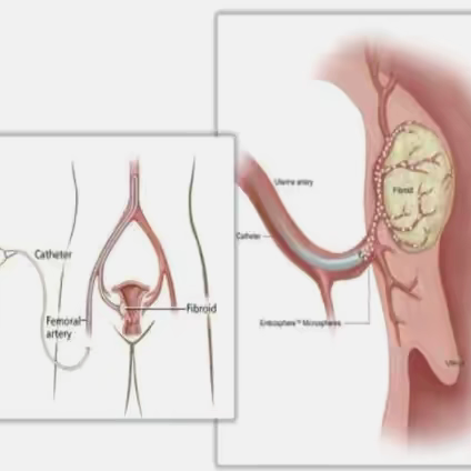 健康科普—子宫动脉栓塞术