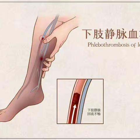 健康科普—如何预防骨折后静脉血栓形成