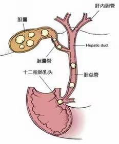 胆囊结石的健康宣教