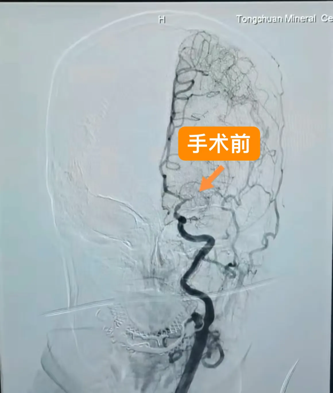 简篇-铜川矿务局中心医院成功实施铜川市首例左侧大脑中动脉慢性闭塞开通术 简篇-铜川矿务局中心医院成功实施铜川市首例左侧大脑中动脉慢性闭塞开通术