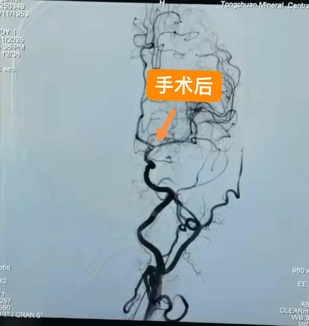 简篇-铜川矿务局中心医院成功实施铜川市首例左侧大脑中动脉慢性闭塞开通术 简篇-铜川矿务局中心医院成功实施铜川市首例左侧大脑中动脉慢性闭塞开通术