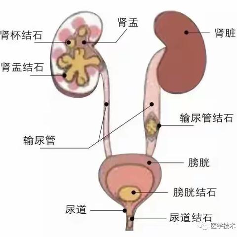 安阳市第六人民医院·泌尿外科科组织开展“泌尿系结石”科普大讲堂