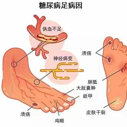 糖尿病足，伤不起的狠“脚”色