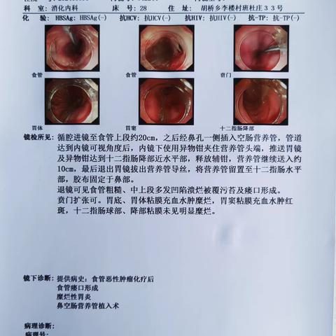 夏邑县人民医院消化内科成功完成经胃镜鼻空肠营养管置入术一例