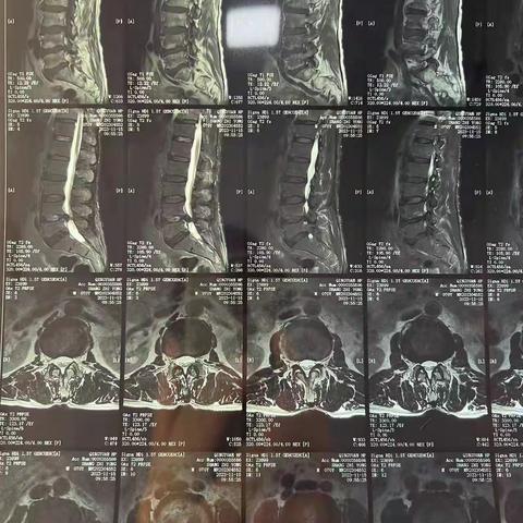 【提质增效篇】我院骨科成功开展全麻下椎间孔镜间盘摘除术