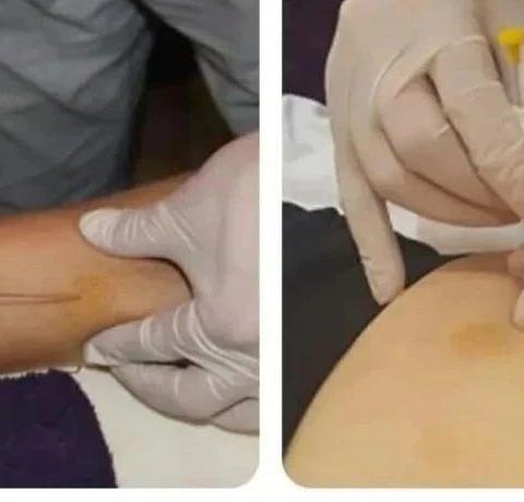 关于举办穴位埋线治疗综合技术培训班的通知（2025年6月20日郑州）