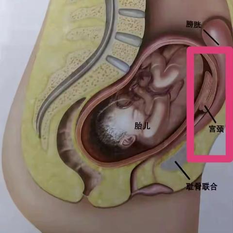 孕妇突发排尿困难，警惕产科急诊--“子宫箝闭”引起的尿潴留