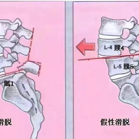 骨伤一科———-摆脱腰痛困扰