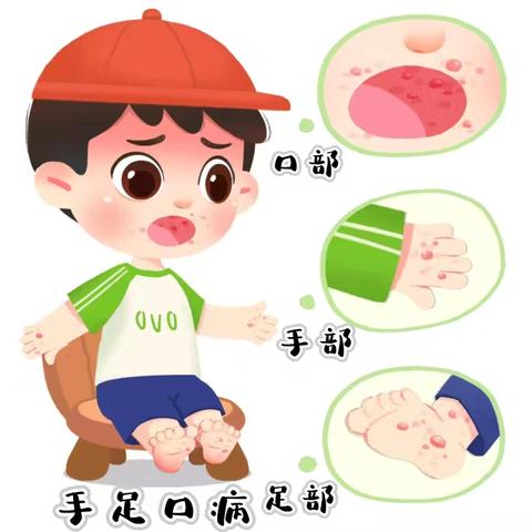 守护宝贝健康 了解手足口病预防与治疗知识