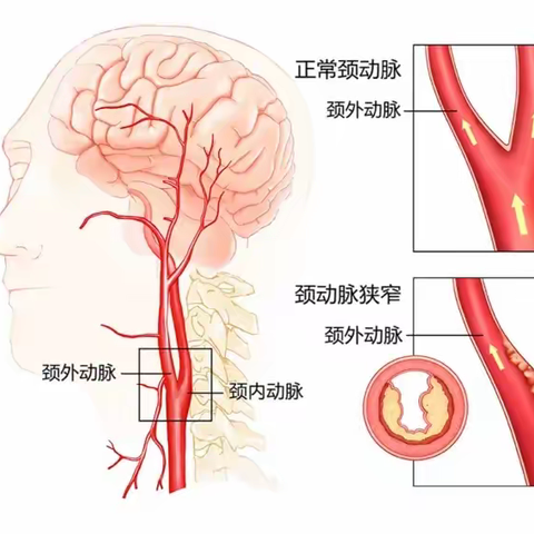 颈动脉狭窄与脑梗或只一步之遥