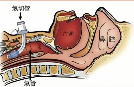 成功拔除气切套管，助力患者重获新“声”