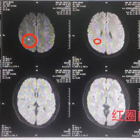 急性脑梗死的救命神针-静脉溶栓