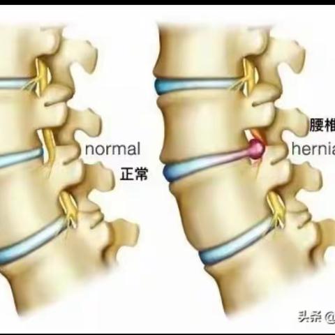 腰椎间盘突出是怎么回事（看图理解）