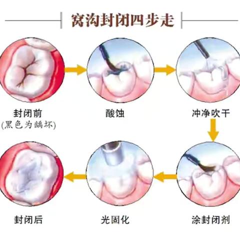 从蛀牙到拔牙，你珍惜你的牙齿了吗？