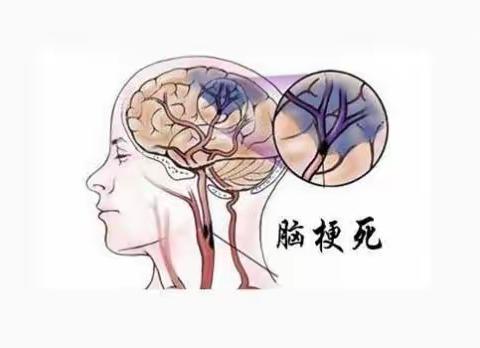 脑卒中的护理查房