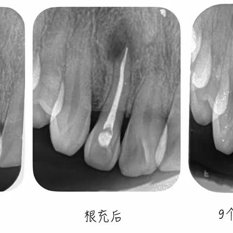 【义马雅康口腔门诊部】根管治疗的流程及治疗失败原因分析