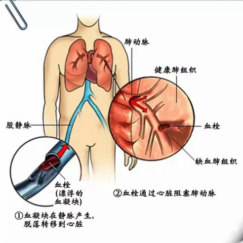 危在旦夕肺栓塞，介入溶栓救病患！