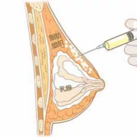 太惊讶了！脂肪丰胸有什么危害和后遗症吗？自体脂肪填充的利弊？