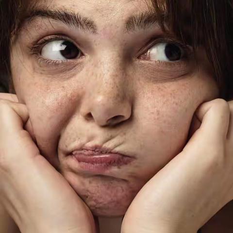 点亮肌肤，让雀斑无处循形---康乐县中西医结合医院皮肤诊疗中心强脉冲光治疗雀斑