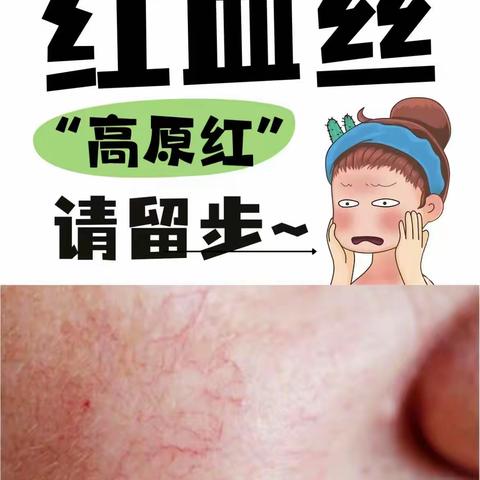 红血丝不再“闹红脸”，强脉冲光来“灭火”---康乐县中西医结合医院皮肤科强脉冲光祛红血丝