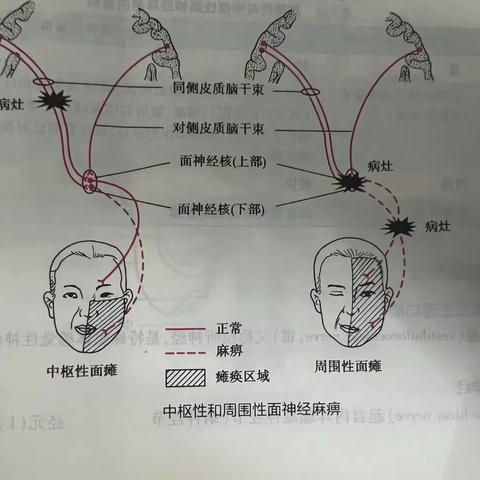 面瘫的护理