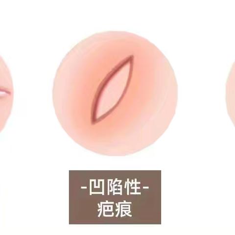 瘢痕———科普