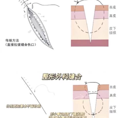科普｜缝合的“艺术”：整形外科比其他外科，瘢痕为何最小？