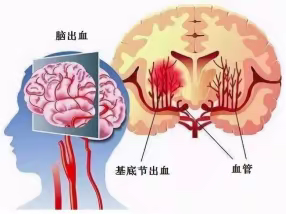 降温预警 防寒、防冻、 防高血压脑出血！