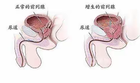 “男言”之隐别硬抗-前列腺增生